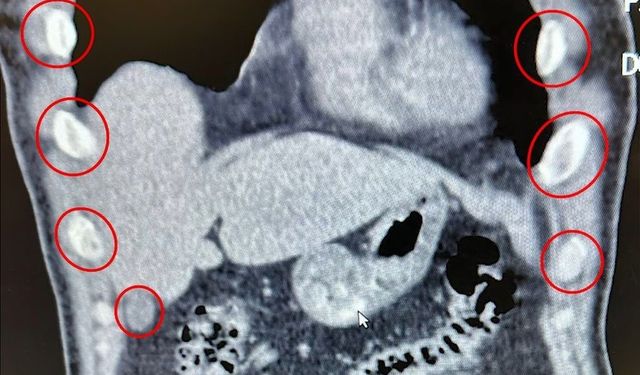 Midelerinden 136 kapsül uyuşturucu çıktı