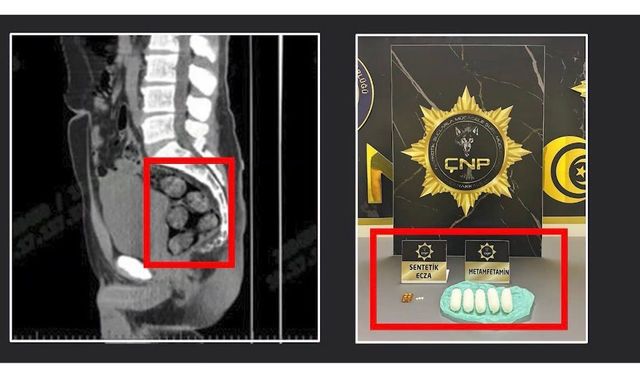 Tomografide şok eden görüntü...Uyuşturucu midesinden çıkarıldı