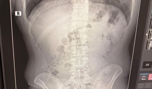 Uşak’ta midelerinden uyuşturucu çıktı: İranlı 3 kişi tutuklandı