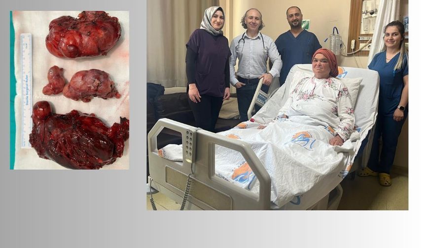 Nefes Darlığı Çeken Hastadan 1120 Gramlık Guatr Alındı